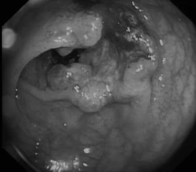cancer-in-colon-rectum BW